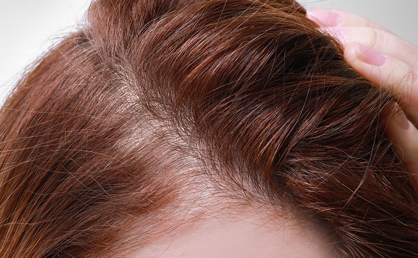Hormone Replacement Therapy Help with Hair Loss